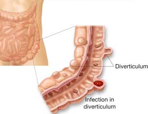 diverticolitejpg