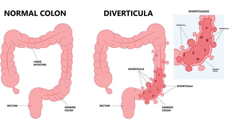 I Diverticoli Pregiudizi Leggende e Verità