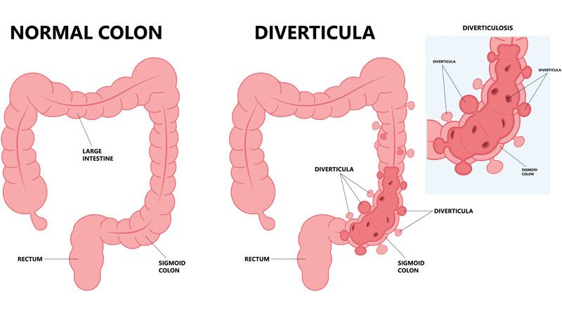 I Diverticoli Pregiudizi Leggende e Verità